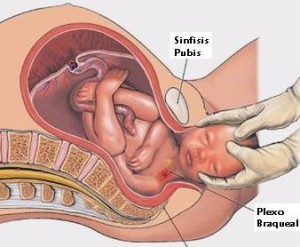 Paralisis braquial obstetrica - Caso medico