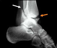 artrosis tras fractura de tobillo mal diagnosticada