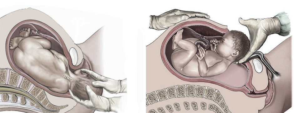 Negligencia medica parto